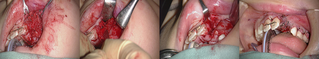 口唇口蓋裂の治療例（Ⅰ期治療）　左側口唇顎裂に起因する上顎前歯部叢生　顎裂部骨移植術　術中写真